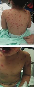 Stevens johnson syndrome (sjs) is a rare vesiculobullous disease characterized by an acute cutaneous eruption that involves the skin and mucosal membranes. Stevens Johnson Syndrome Consultant360
