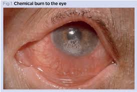 In the event that the lens remains stuck, rinse several more times. Procedure For Eye Irrigation To Treat Ocular Chemical Injury Nursing Times