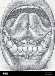 Image result for tonsilla palatina