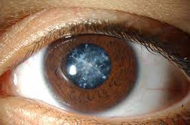 Can Cataracts cause Blindness? | Delhi Eye Center