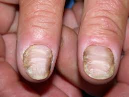 Image result for onychomycosis