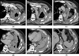 Malignant pleural mesothelioma radiology staging. The Role Of Imaging In Malignant Pleural Mesothelioma An Update After The 2018 Bts Guidelines Clinical Radiology
