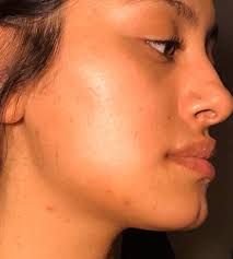 The estimated cost for most fillings includes the price of a local anesthesia. How Many Ml Of Cheek And Chin Filler Do I Need Photos