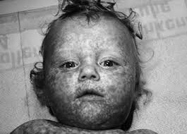 Anita is married, has 2 children and has been living in switzerland since 1980. Autismus Durch Masern Impfung