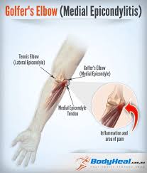 Golfer's elbow is common in manual workers and those that play racquet sports and lift heavy weights. A Physical Therapist Take On Golfer S Elbow Golfers Elbow Golfers Elbow Treatment Tennis Elbow