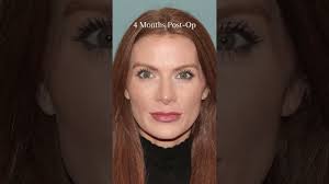 Victoria's Rhinoplasty Journey