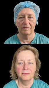 Lifting facial resultados✨💉 By Dr. Rubí Márquez , •••, Results of facial  lifting✨💉 By Dr. Rubí Márquez , Agenda tu cita!, Vía DM, 📞🇲🇽658 517  0818, 📞🇺🇸(928) 239 5015, #lifting #faciallifting #fullface ...