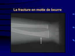 Pathologie Osseuse Traumatique Ppt Telecharger