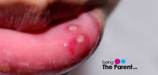 Tongue toddler mouth sores pictures. Canker Sores In Children Symptoms Causes Treatment And Prevention Being The Parent