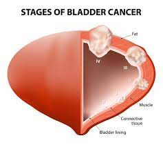 What are the warning signs of bladder cancer? Bladder Cancer Types