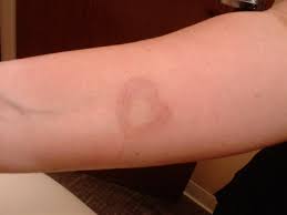 About 50% to 75% fewer treatments needed. Laser Tattoo Removal Training Synnx