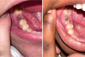 Image result for Tooth Extraction