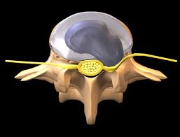 En slik skade skjer som regel på grunn av langvarig slitasje på det tar tid, mye behandling og mye egeninnsats. Prolaps I Ryggen Isjias Nhi No