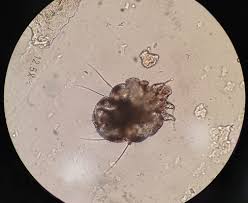 Image result for Sarcoptes scabiei