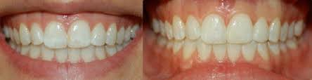 Remember that your teeth have a significant role in your overall personality. How To Get Rid Of White Spots On Teeth And Keep Them Away