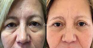 Blefaroplastia Superior E Inferior Caso Clinico 46280