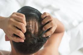 The medicine will not cure hair loss, but it will cause scalp hair to grow. Finasteride For People Suffering From Male Pattern Hair Loss