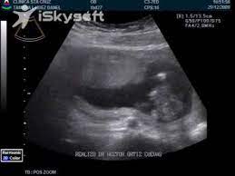 Ultrasonido De Nuestro Bebe De 14 Semanas 29 Dic 2009 Youtube