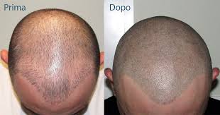 La micro pigmentazione, conosciuta anche come trucco permanente o semipermanente, è una specialità estetica che prevede l'introduzione nella cute, per mezzo di . Trico New Life La Tricopigmentazione Pigmentazione Per Capelli Da Cui Il Prefisso Trico E Un Settore Specifico Della Micropigmentazione E Una Tecnica Innovativa E Reversibile Che Consente Di Mascherare La Calvizie