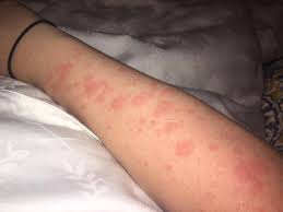 23 Honest Photos Of The Embarrassing Sides Of Autoimmune Disease We Don T Talk About Autoimmune Autoimmune Disease Autoimmune Disease Symptoms