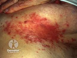 Image result for Candidiasis under breasts