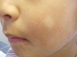 Instead, post a link to the place where it has been released. Reasons For White Skin Patches In Children Healthy Living