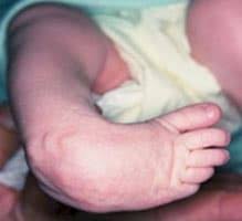 As clubfoot condition is present at birth, inward and downward turned feet position, that resists realignment, is considered as the main symptom of clubfoot. Clubfoot Treatment Doctor Orange County Dr Kolodenker