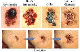 In the united states, it's estimated that doctors diagnose over 100,000 new skin cancer cases each year. Risk Factors For Cancer