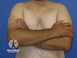 Image result for Diffuse Hyperpigmentation