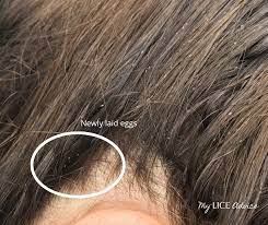 Synthetic fibers can be knit and woven similarly to natural fibers. Flat Ironing To Kill Lice And Nits