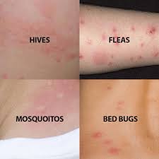 Image result for bedbugs bites