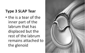 Image result for SLAP Lesion