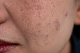 Image result for Melasma
