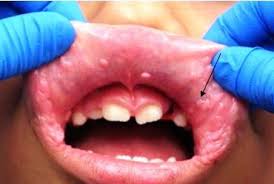 Image result for papillomavirus tongue)