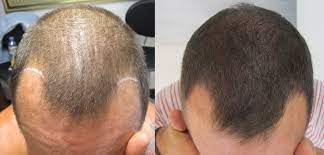Balding involves excessive shedding and can be the result of certain medications, heredity, or even an underlying medical condition. How To Regrow Hair In Bald Patches Naturally Regrow Hair