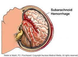 All blood vessels can bleed, but bleeding of a blood vessel in the brain is not common. Types And Causes Of Infant Brain Bleeds Hemorrhages