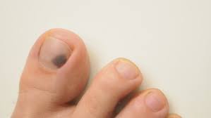 It's a toenail fungal infection, so what else is there to know? Sick Nail Trauma To The Stock Footage Video 100 Royalty Free 1020817753 Shutterstock