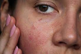 However, you could still try using. Facial Redness Veins Victorian Dermal Group