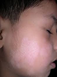 A continuación hablaremos de las causas de las manchas blancas en la piel, relacionadas con la hipopigmentación. Manchas Blancas En La Cara Curiosidades Medicas Online Facebook