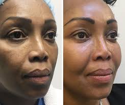 Best Treatment For Non Surgical Facelift What Are The Best Alternatives To A Surgical Facelift