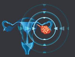Cancer of the ovary is not common, but it causes more deaths than other female reproductive cancers. Targeting Stem Like Cells Could Prevent Ovarian Cancer Recurrence Drug Discovery And Development