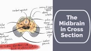 Crossed brainstem syndrome revealing bleeding brainstem cavernous malformation: Midbrain In Cross Section Youtube