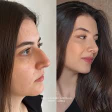 NARIZ + LÁBIO + MENTO = PERFIL PERFEITO 😮‍💨 Apenas 30 minutos separa o  antes do depois 👃🏼👄💉 • Rinomodelação com ácido hialurônico •  Preenchimento labial • Preenchimento de mento DRA. BÁRBARA CASTILHO CROSP  148964