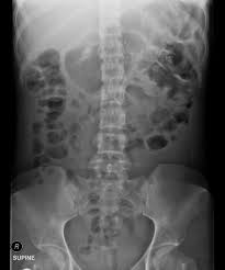 Chronic Pancreatitis Radiology Case Radiopaedia Org Radiology Nursing School Clinicals Radiology Technician