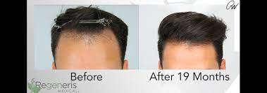 Amazing stem cell hair restoration before & after photo. Stem Cell Hair Restoration Tampa Stem Cell Hair Therapy