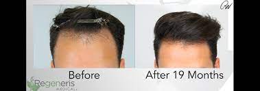Prp helps in stopping hair fall as well as helps in growth of hairs whereas. Stem Cell Hair Restoration Tampa Stem Cell Hair Therapy