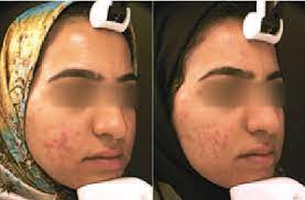 Анализатор кожи mark vu new. 23 Year Old Woman With Acne Vulgaris Pre Right And 5 Weeks Post Download Scientific Diagram