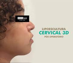LIPOESCULTURA CERVICAL 3 D A lipoaspiração cervical é um procedimento para  remoção de gordura sub-mentoniana (papada) indesejada, conferindo  jovialidade, bem-estar emocional e por consequência eleva a autoestima.  Lembrando que as características faciais