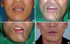 Purpose the fujimori gate flap is an innervated flap raised from the nasolabial area for reconstruction of the lower lip. Lower Lip Reconstruction After Wide Excision Of A Malignancy With Barrel Shaped Excision Or The Webster Modification Of The Bernard Operation