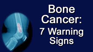 Bone pain can cause a dull or deep ache in a bone or bone region (e.g., back, pelvis, legs, ribs, arms). Bone Cancer 7 Warning Signs 14th International Conference On Arthroplasty And Arthroscopy